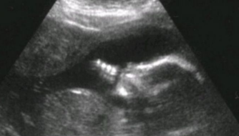 Tronditen gjinekologët, ja çfarë i nxjerrin kësaj gruaje nga mitra