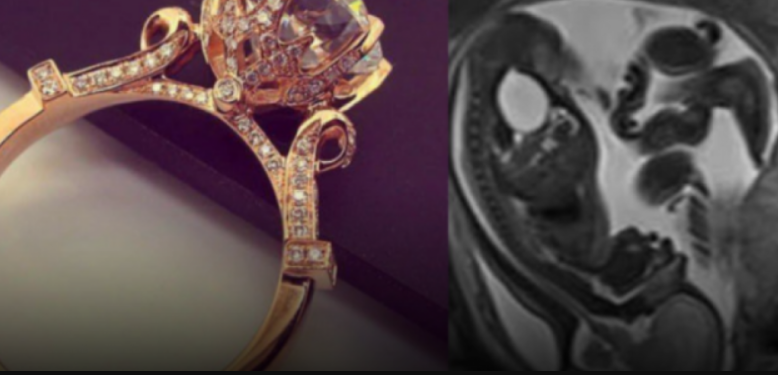 Kujdes nëna, ja si ndikojnë bizhuterië gjatë shtatzanisë