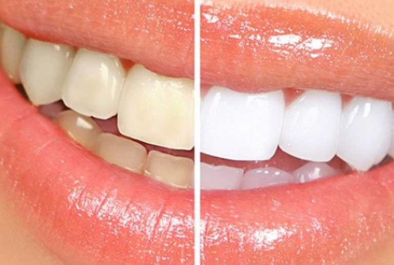 Metoda që dentisti nuk e thotë, ja si ti zbardhni dhëmbët dhe hiqni gurrëzat në kushte shtëpie