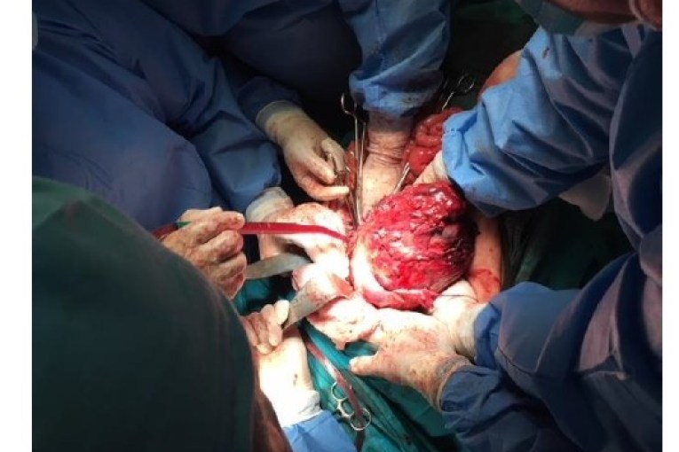 T’i heqësh pacientit tumorin 18 cm, flet Dr. Kasumaj: ju rrëfej përjetimet e një operacioni të rrallë