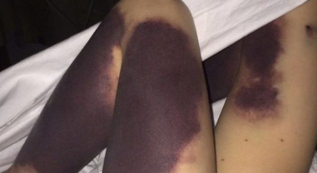 Bija e tyre zgjohet me të nxira nëpër trup, ajo ç’farë kishte ishte…