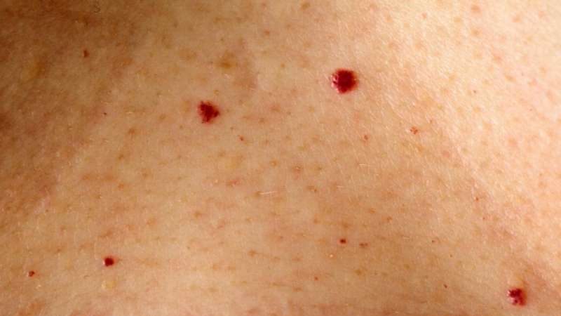 A duhet të shqetësoheni nëse i keni këto njolla të kuqe në trup?