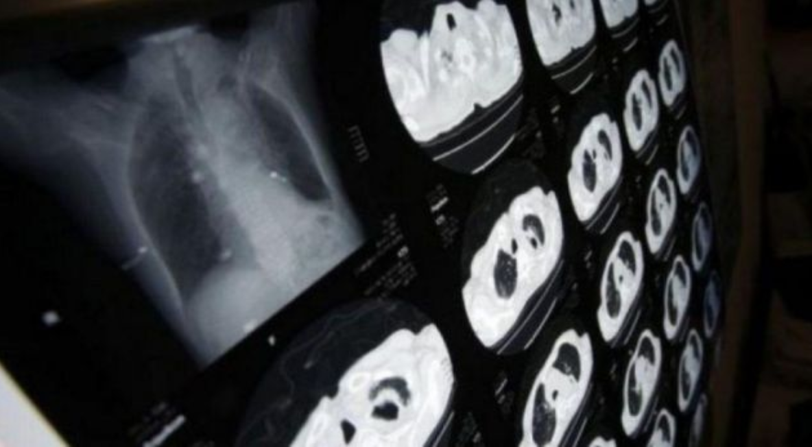 Jo vetëm kanceri dhe sëmundjet e zemrës, mësoni sëmundjen e re që mer jetë njerëzish