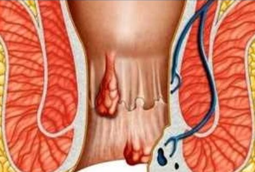 Mahniten edhe doktorët, këto janë metodat më të mira natyrale për shërim të hemorroideve