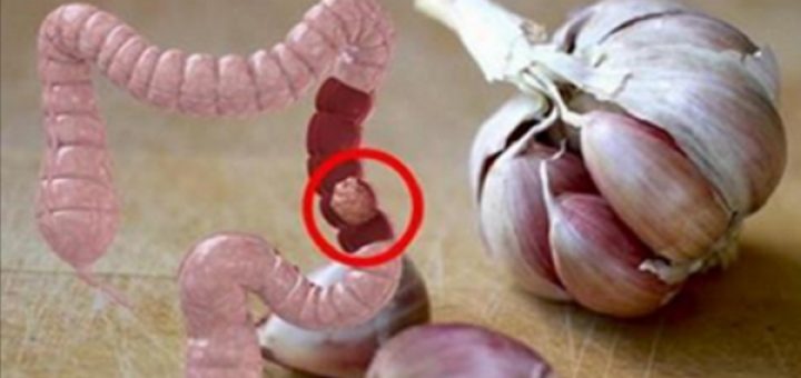 Parandaloni kancerin e zorrës së trashë duke eliminuar këto ushqime