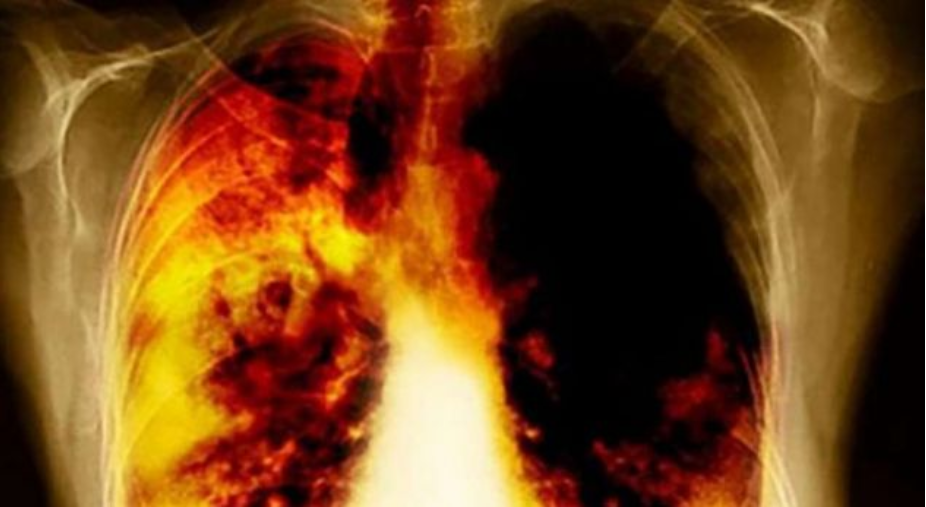 Ky gaz pa erë është shkaku i dytë kryesor i kancerit të mushkërive