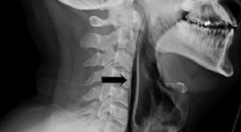 E mbani teshtimën? Ja nga çfarë rrezikoheni?