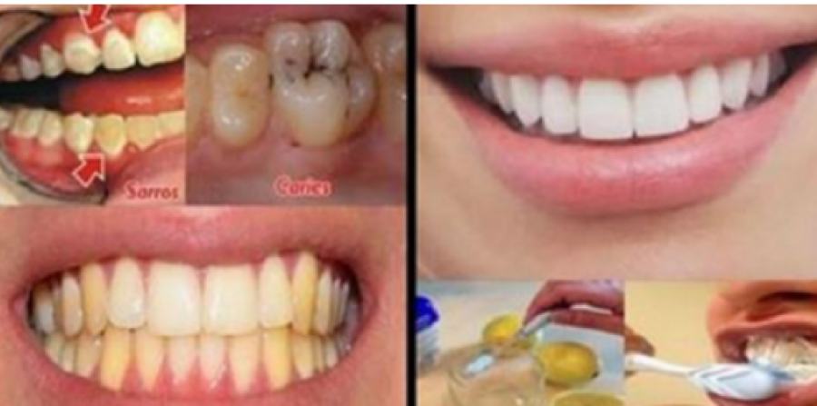 Lamtumirë dentist! Ja çfarë duhet të bëni për të pasur dhëmbë perfektë