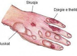 Këtë duhet të bëni menjëherë pasi pësoni djegie