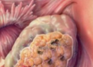 Ky produkt shkakton kancerin tek gratë