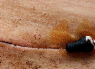 Kujdes: Ky mund të jetë numri maksimal i prerjeve cezariane që një grua mund të ketë