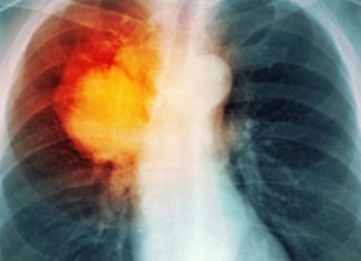 Sëmundja e frikshme e mushkërive që prek më shumë gratë se burrat