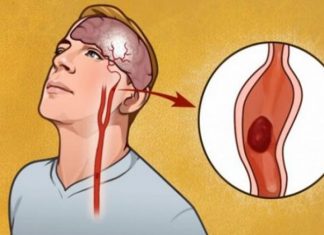 Si ta kuptoni kur dikush ka pësuar një goditje në tru? Ky veprim i vetëm do i shpëtojë jetën