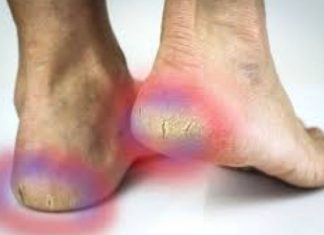 Si t’i shëroni thembrat e çara vetëm me sodë buke