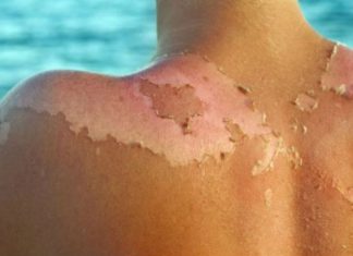 Çfarë është helmimi nga dielli dhe si të ruheni