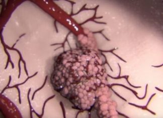 Xhirimi i paparë, ja mënyra se si kaneri përhapet në organizëm (VIDEO)