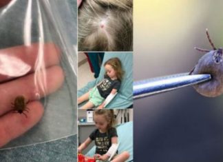 Pickimi i një insekti gati la të paralizuar vajzën 5-vjeçare