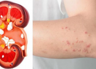 Këto janë shenjat që tregojnë se veshkat tuaj nuk funksionojnë siç duhet