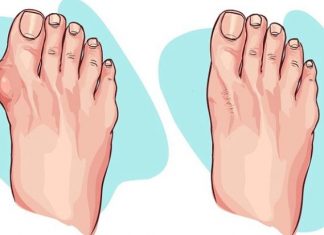 Si t’i hiqni gungat e formuara tek gishti i madh i këmbës në mënyrë natyrale