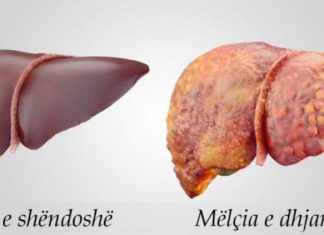 Këto janë katër ilaçe të forta natyrale kundër dhjamosjes së mëlçisë