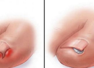 Ju rriten thonjtë nën lëkurë? Ja si duhet të veproni