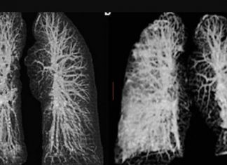 Pamjet shqetësuese, çfarë u bën mushkërive koronavirusi