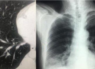 “Koronavirusi që prej 15 janarit në Shqipëri”, mjeku Gëzim Xhepa publikon imazhet pulmonare