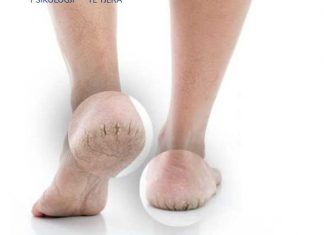 Si t’i shëroni thembrat e çara në mënyrë natyrale?