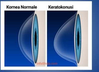 Çfarë është keratokonusi dhe si trajtohet kjo sëmundje e syve?