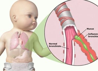 Infeksioni i mushkërive tek bebet: Çfarë e shkakton bronkiolitin tek bebet dhe si ta trajtojmë?