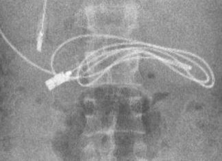 Turqi: 15-vjeçarit mjekët ia heqin nga barku adapterin e telefonit (VIDEO)