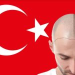 Gati 1 milion njerëz shkuan në Turqi për të mbjellë flokët, shpenzuan rreth 2 miliardë dollarë