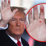 Trump i sëmurë rëndë?! Ish-presidenti amerikan është fotografuar me “njolla të çuditshme në duar”