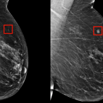 Intelegjenca artificiale zbulon kancerin e gjirit 5 vjet para se të zhvillohet