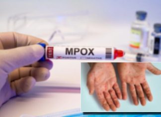 Çfarë është lija e majmunit dhe si përhapet? Ja shenjat e para që tregojnë se jeni infektuar nga kjo sëmundje ngjitëse