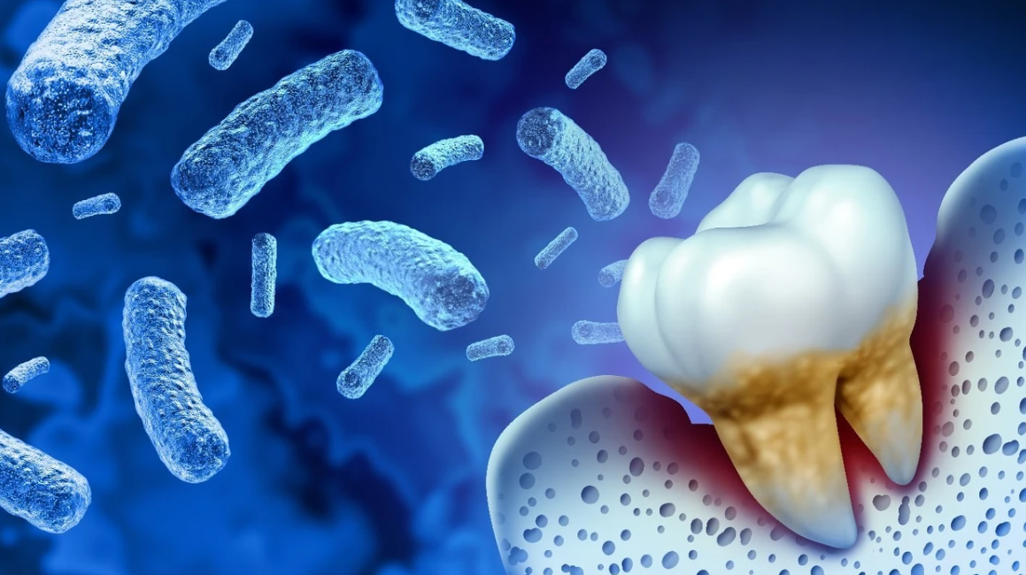 Sëmundja e mishrave të dhëmbëve mund ta përkeqësojë sklerozën multiple dhe ta rrisë invaliditetin