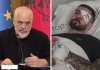 Rama reagon për plagosjen e 28-vjeçarit në sy: Pasojë e dhunës, u kujdesa personalisht të shkojë në spitalin më të mirë në Itali
